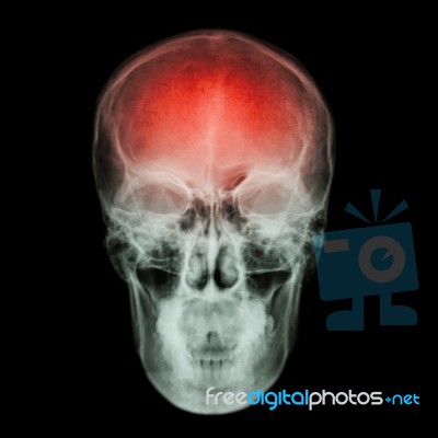 X-ray Skull And Stroke ( Cerebrovascular Accident (cva) ) Stock Photo