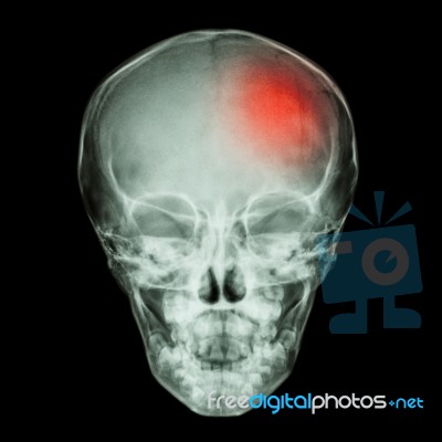 X-ray Skull Of Child And Stroke (cerebrovascular Accident) Stock Photo