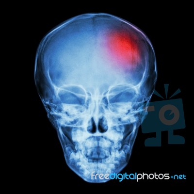 X-ray Skull Of Child And Stroke (cerebrovascular Accident) Stock Photo