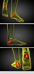 3d Render Medical Illustration Of The Calcaneus Bone Stock Photo