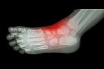 Arthritis And Injury At Ankle  :  Film X-ray Of Child 's Foot ( Side View ) ( Lateral ) Stock Photo