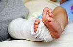 Baby Foot In Bandage And Cast Stock Photo