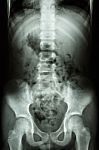 Child's Spine ,abdomen ,pelvis ,hip Stock Photo