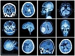 Collection Of Brain Disease ( Ct Scan And Mri Of Brain : Show Cerebral Infarct , Intracerebral Hemorrhage , Brain Tumor , Basal Ganglia Hemorrhage ( Status Post Craniotomy ) ) ( Health Care Concept ) Stock Photo