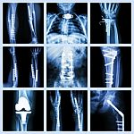 Collection Of Orthopedic Operation Stock Photo