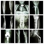 Collection Of Orthopedic Operation Stock Photo