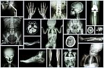 Collection X-ray Multiple Adult And Child's Organ & Orthopedic Surgery & Multiple Disease (stroke , Osteoarthritis Knee , Fracture Bone , Etc) Stock Photo