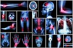 Collection X-ray Multiple Disease (arthritis,stroke,brain Tumor,gout,rheumatoid,kidney Stone,pulmonary Tuberculosis,osteoarthritis Knee, Etc) Stock Photo