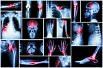 Collection X-ray Multiple Disease (stroke ,fracture ,osteoarthritis ,pneumonia ,tuberculosis ,spondylosis ,spondylolisthesis ,gout ,rheumatoid Arthritis ,brain Tumor ,orthopedic Operation ,etc) Stock Photo