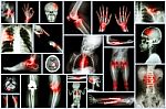 Collection X-ray Multiple Human's Organ & Orthopedic Surgery & Multiple Disease (pulmonary Tuberculosis , Gout , Rheumatoid Arthritis ,spondylosis , Fracture Bone , Stroke , Brain Tumor , Etc) Stock Photo