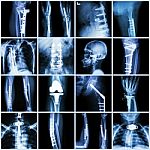 Collection X-ray Orthopedic Surgery (multiple Part Of Human, Operate And Internal Fixation By Plate&screw ) Stock Photo