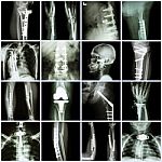 Collection X-ray Orthopedic Surgery (multiple Part Of Human, Operate And Internal Fixation By Plate&screw ) Stock Photo