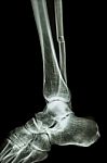 Complete Fracture Shaft Of Fibula (leg's Bone) Stock Photo