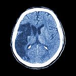 Ct Brain : Show Ischemic Stroke (hypodensity At Right Frontal-pa Stock Photo