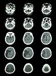 Ct Scan (computed Tomography) Of Brain Show Cerebral Infarction Stock Photo