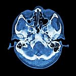 Ct Scan Of Brain And Base Of Skull  ( Bone Window ) Stock Photo