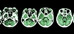 Ct Scan Of Brain And Base Of Skull ( Show Structure Of Eye , Ethmoid Sinus , Cerebellum , Cerebrum, Etc ) Stock Photo