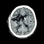 Ct Scan Of Brain : Show Old Right Basal Ganglia Hemorrhage With Brain Edema ( Status Post Craniotomy ) ( Hemorrhagic Stroke ) Stock Photo