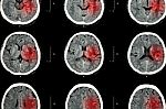 Ct Scan Of Brain With Red Area ( Imaging For Hemorrhagic Stroke Or Ischemic Stroke ( Infarction ) Concept ) Stock Photo