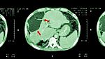 Ct Scan Of Upper Abdomen : Show Abnormal Mass At Liver ( Liver Cancer ) Stock Photo