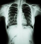 Film Chest X-ray : Show Normal Chest Of Woman Stock Photo