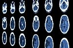 Film Ct Scan Of Brain Show Ischemic Stroke And Hemorrhagic Strok Stock Photo