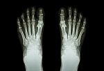 Film X-ray Both Foot ( Front View ) Stock Photo