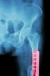 Film X-ray Fracture Femur(thigh Bone). It Was Operated And Inter Stock Photo