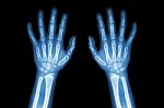 Film X-ray Normal Both Hands Of Child Stock Photo