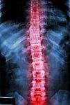 Film X-ray T-l Spine(thoracic-lumbar Spine) Show : Human's Thoracic-lumbar Spine And Inflammation At Spine Stock Photo