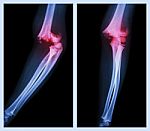 Fracture Elbow (left Image : Side Position , Right Image : Front Position) Stock Photo