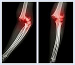 Fracture Elbow (left Image : Side Position , Right Image : Front Position) Stock Photo