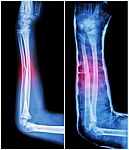 Fracture Shaft Of Ulnar Bone ( Forearm Bone )  : ( Left : Pre-treatment  ,  Right : Psot-treatment (splint With Cast) ) Stock Photo