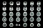 Hemorrhagic Stroke And Ischemic Stroke .  Ct Scan Of Brain : Intracerebral Hemorrhage ( 3 Left Column , Cerebral Infarction ( 3 Right Column )) ( Medical And Science Background ) Stock Photo