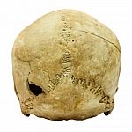 Human Skull Fracture (backside)  (mongoloid,asian) On Isolated B Stock Photo