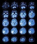 Mri Brain : Brain Tumor At Right Parietal Lobe Stock Photo