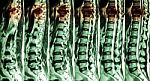 Mri Of Lumbar & Thoracic Spine : Show Fracture Of Thoracic Spine And Compress Spinal Cord ( Myelopathy ) Stock Photo