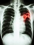 Mycobacterium Tuberculosis Infection (pulmonary Tuberculosis) Stock Photo