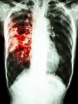 Mycobacterium Tuberculosis Infection (pulmonary Tuberculosis) Stock Photo