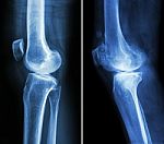 Normal Knee ( Left Image ) And Osteoarthritis Knee ( Right Image ) ( Lateral View ) Stock Photo