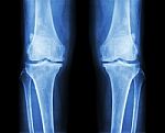 Osteoarthritis Both Knee .  Film X-ray Ap ( Anterior - Posterior ) Of Knee Show Narrow Joint Space , Osteophyte ( Spur ) , Subcondral Sclerosis Stock Photo