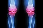 Osteoarthritis Knee ( Oa Knee ). Film X-ray Both Knee ( Front View ) Show Narrow Joint Space ( Joint Cartilage Loss ) , Osteophyte , Subchondral Sclerosis Stock Photo