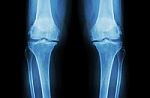 Osteoarthritis Knee ( Oa Knee ). Film X-ray Both Knee ( Front View ) Show Narrow Joint Space ( Joint Cartilage Loss ) , Osteophyte , Subchondral Sclerosis Stock Photo