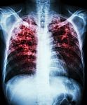 Pulmonary Tuberculosis Stock Photo