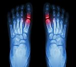 "rheumatoid Arthritis , Gouty Arthritis"  X-ray Child's Foots And Arthritis At Metatarsophalangeal Joint (big Toe Area) Stock Photo