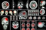 Set , Collection Of Brain Disease ( Cerebral Infarction , Hemorrhagic Stroke , Brain Tumor , Disc Herniation With Spinal Cord Compression ,etc)( Ct Scan , Mri , Mrt )( Neurology And Nervous System ) Stock Photo