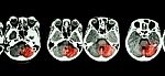 Stroke  ( Ct Scan Of Brain And Base Of Skull And Stroke ) Stock Photo