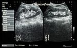 Ultrasonography Of Kidney : Show Left Kidney Stone ( 2 Image For Compare ) Stock Photo