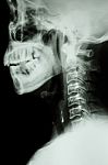 X-ray Cervical Spine Of Asian People Stock Photo