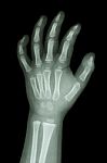 X-ray Infant's Hand Stock Photo